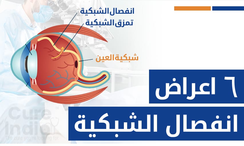 ٦ اعراض انفصال الشبكية قد تحتاج إلى جراحة الشبكية الجسم الزجاجي